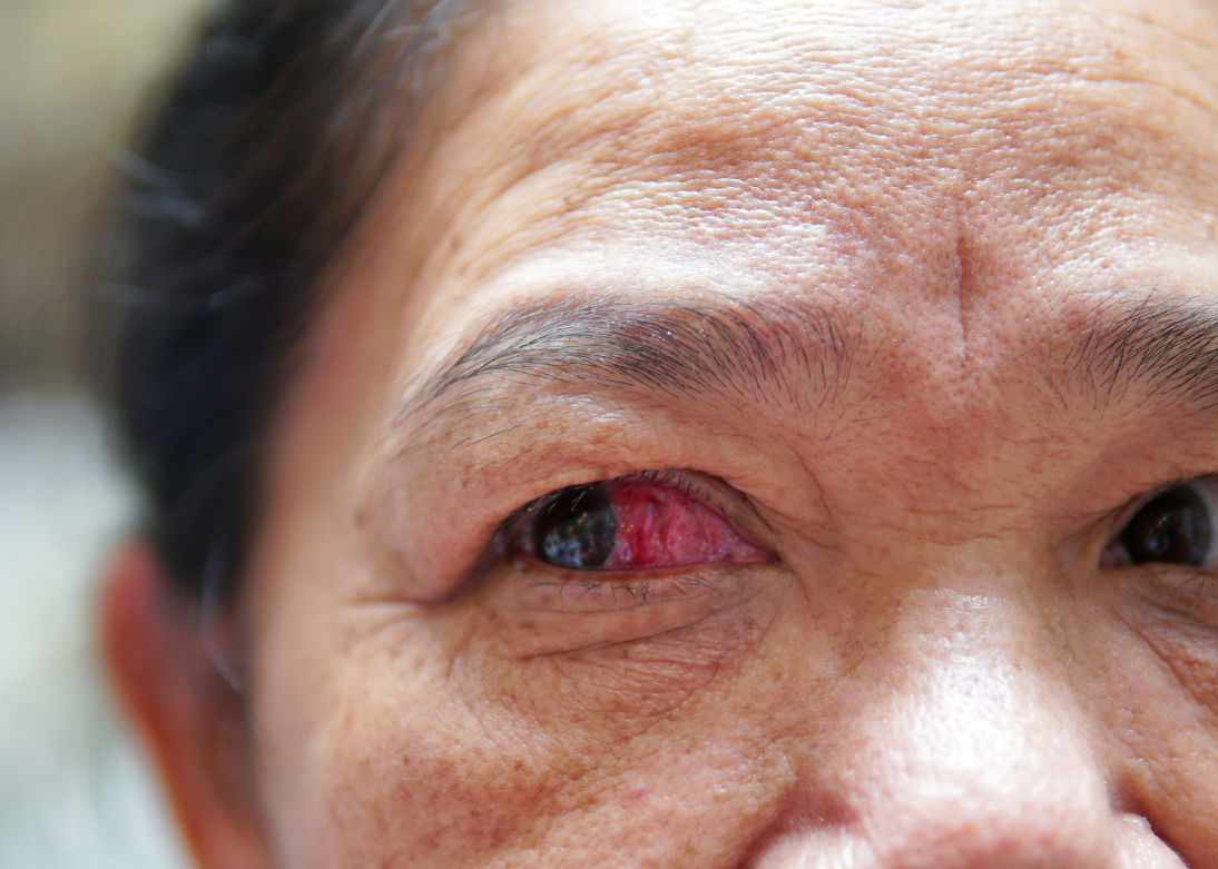 Corneal Transplantation